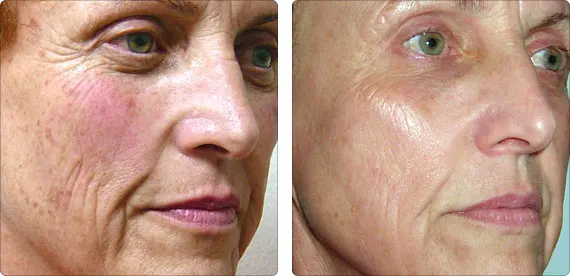 bioeffect before and after