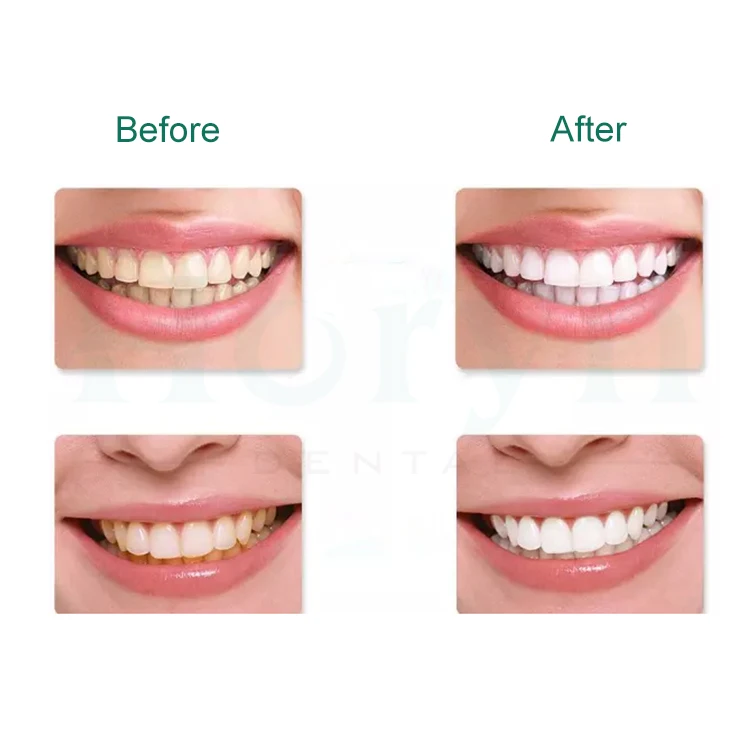 Tooth Bleaching Gel White Silicone Pre Filled 35% Carbamide Peroxide ...