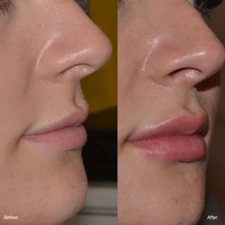 hyaluronic acid filler for lips - buy dermal filler,ha filler