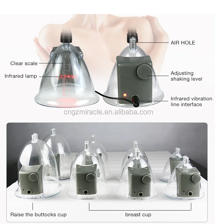 Vacuum-Cupping-01