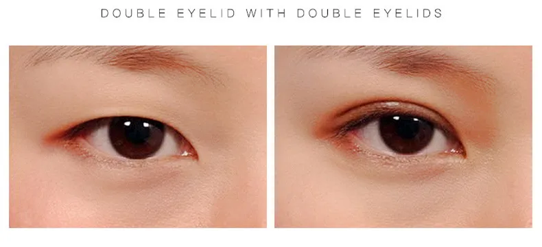 double eyelid lace