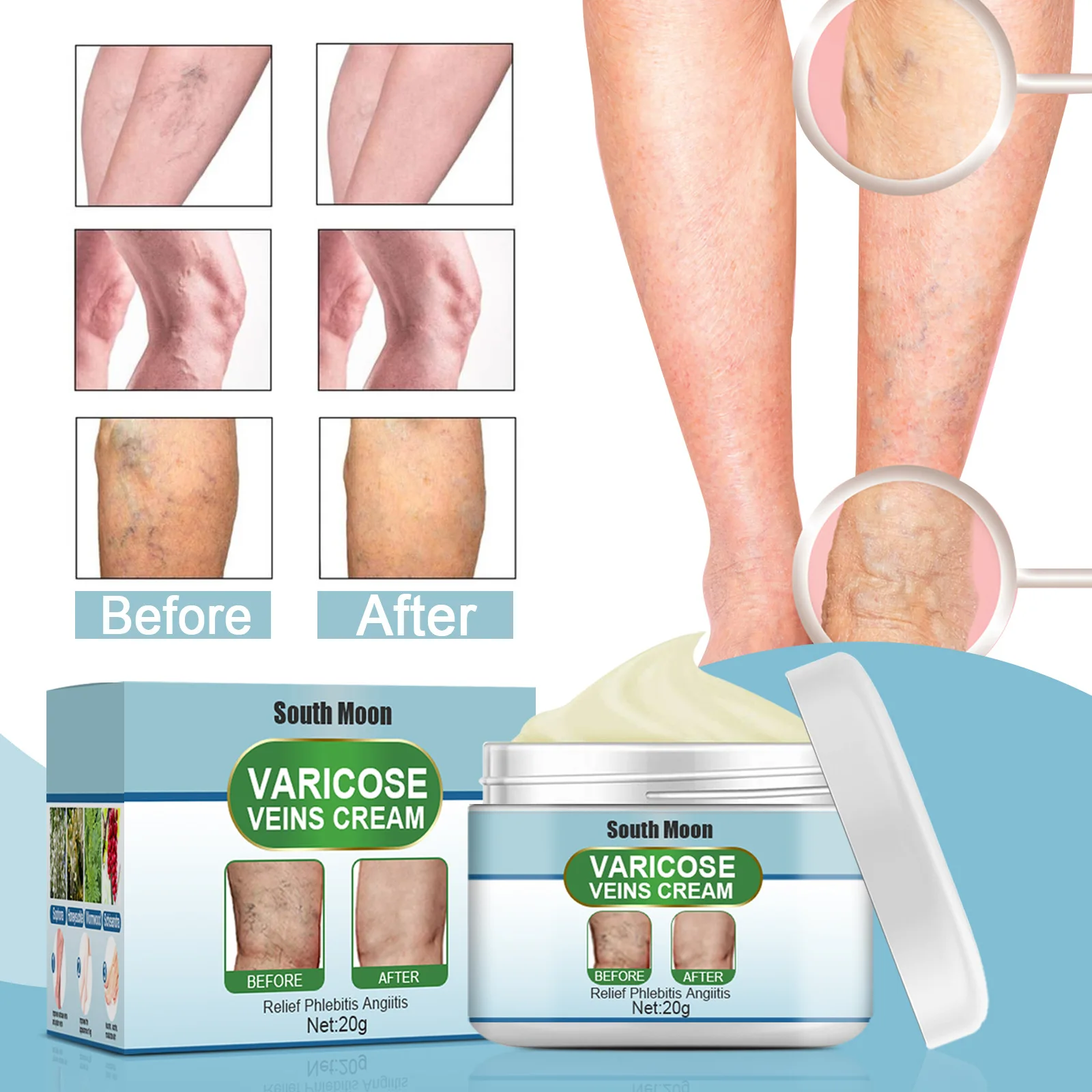 Effective Varicose Veins Relief Cream Relieve Vasculitis Phlebitis