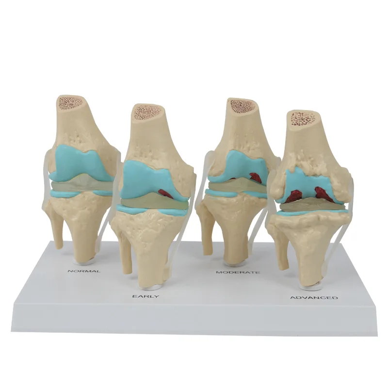 Human Knee Joint Skeletal Model Set Only 4-Stage Osteoarthritis ...