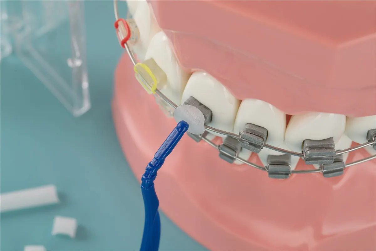 orthodontic relief wax of braces irritation orthodontic wax with