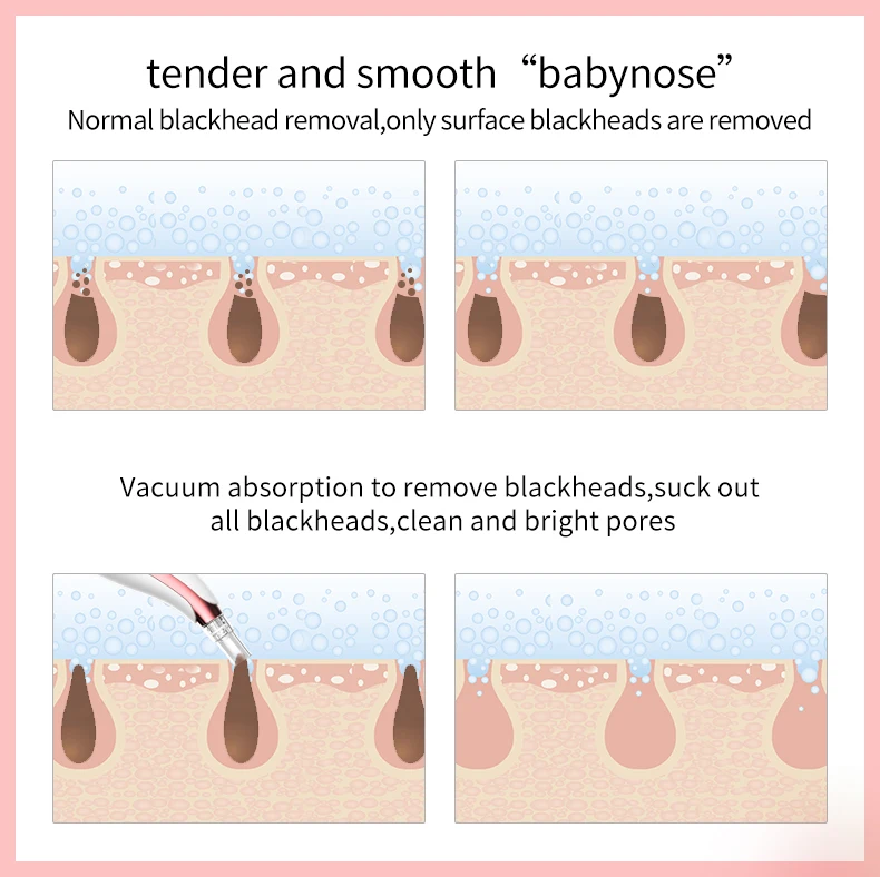 Remove blackheads clean