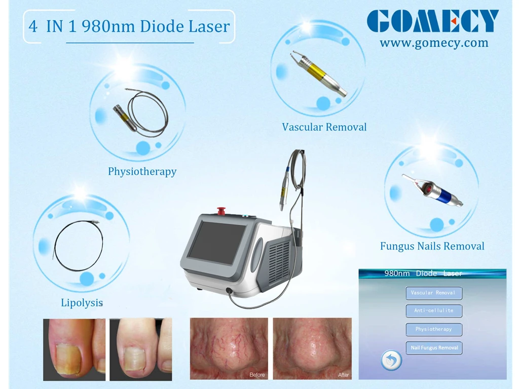980 нм. Диодный лазер 980 НМ для удаления сосудов. Диодный лазер для удаления сосудов 980nm. 980 НМ лазер патоморфология. Portable Surgical Laser System инструкцию по эксплуатации.
