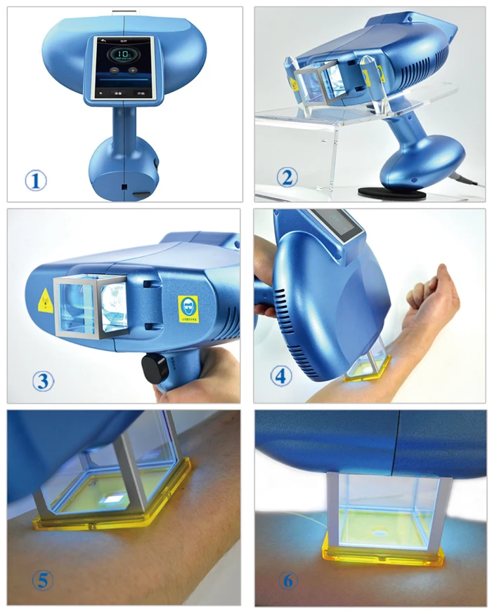 Factory Price 308nm Excimer Laser Psoriasis Vitiligo Treatment Machine Buy 308nm Excimer Laser