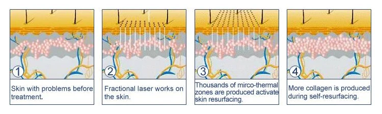 co2 plus fractional laser