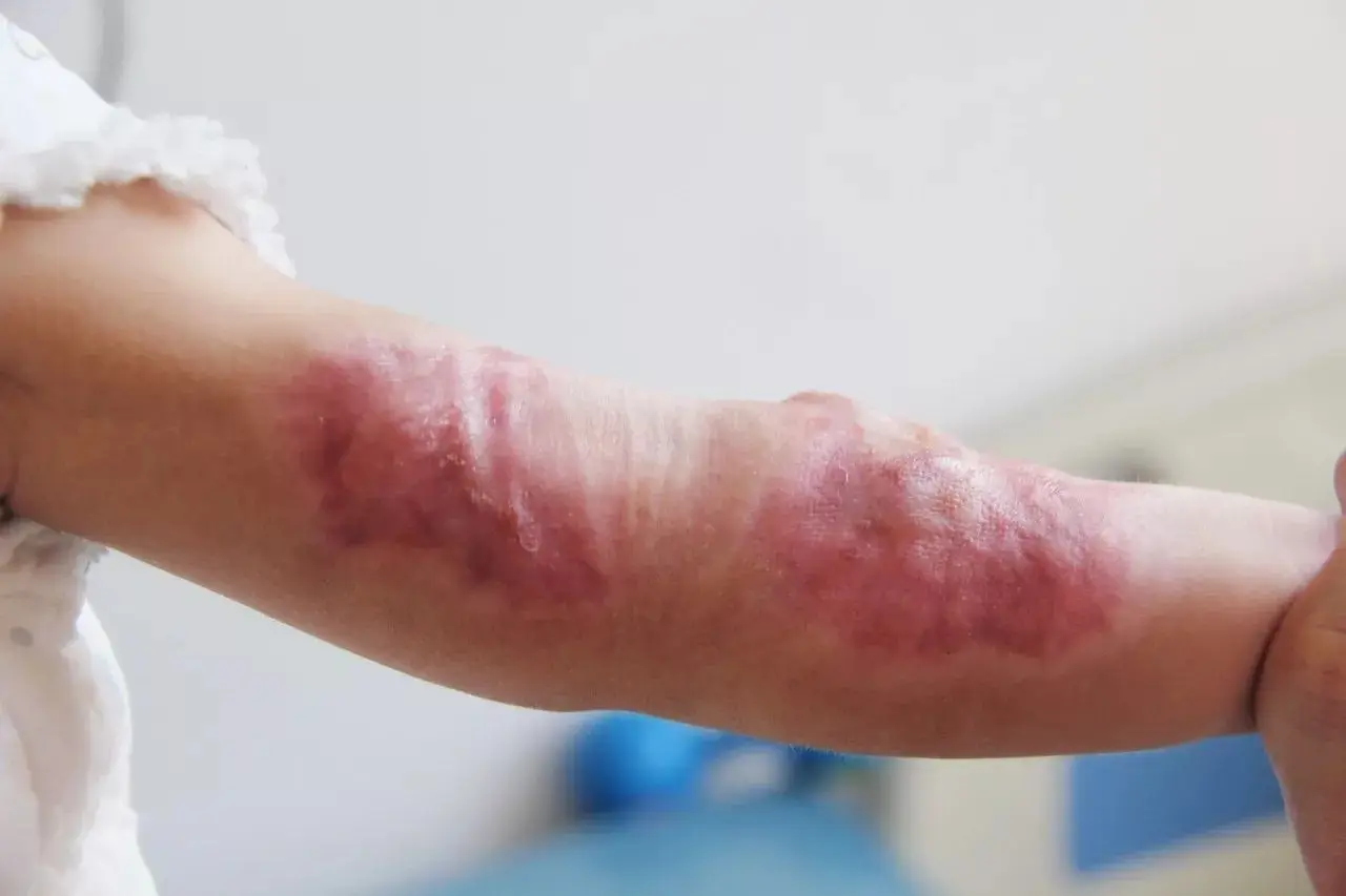 wound dressing 04.jpeg