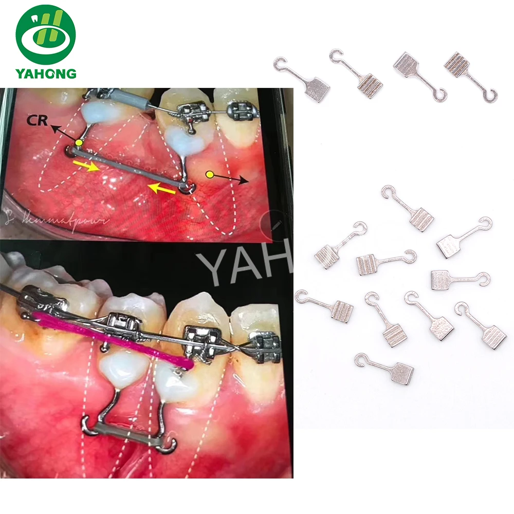 thumbnail interactive-video image 1 of 100 Pack Dental Orthodontic Crimpable Hooks – Short Square 1.8mm Stainless Steel 1 of 6