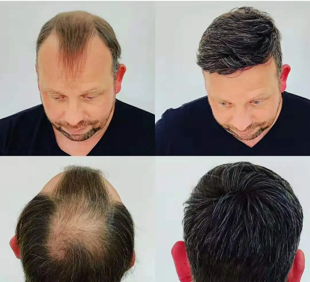 hair loss treatment 650nm hair growth hair regrowth 400 separate diode laser device export Europe  more than 10 years