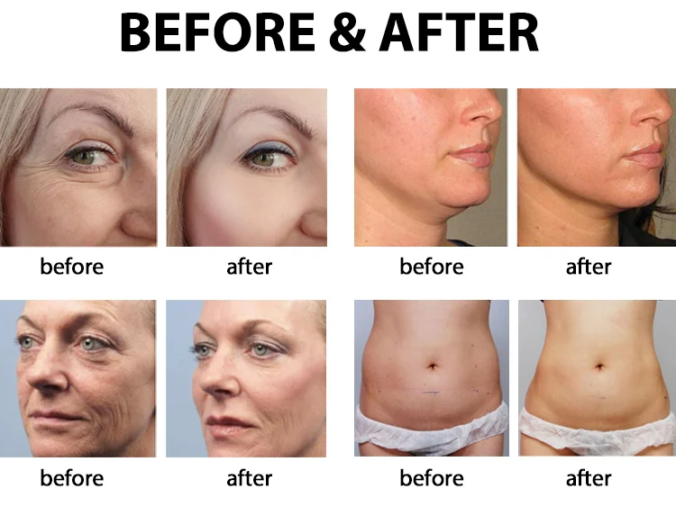 Hifu Sincoheren 4D Hifu Face Body Lift Vaginal Tightening Anti-wrinkle Machine 8 Cartridges with CE