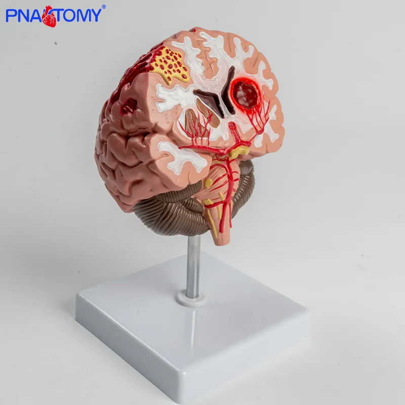 Pvc Brain PVC Brain Anatomical Model Cerebral Hemorrhage and Arteriovenous ...