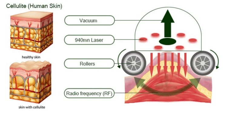 IR+RF+VACUUM+ MASSAGE ROLLER 4-in-1 cellulite reduction cavitation RF vaccum body machine shape/ vela slimming machine