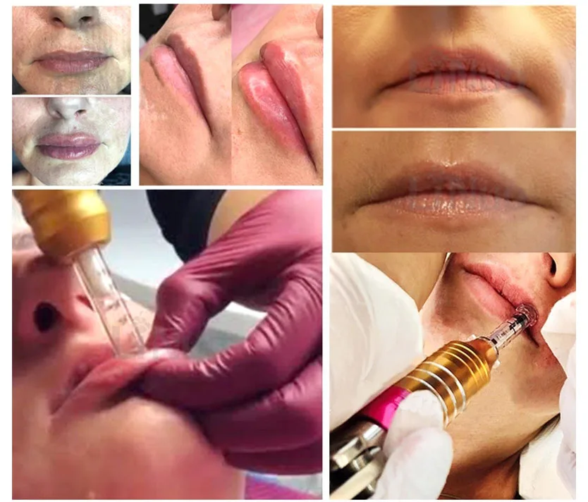 Skinject Hyaluronic Acid 0.5ml Ampoule For Mesotherapy Gun.jpg