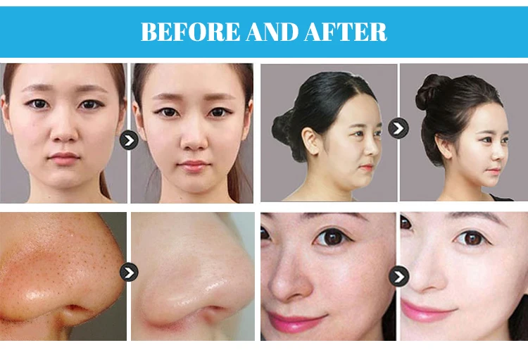 blackhead vacuum7.jpg