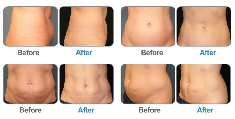 slimming B&A.jpg