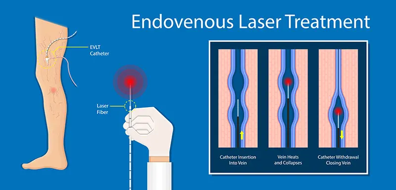varicoza dupa recomandarile laser laser