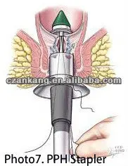 Prolapse hemorrhoids stapler.jpg