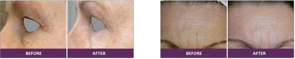 fractional needle Tixel Australia skin care wrinkle remove skin rejuvenation machine