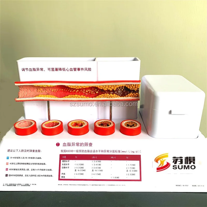 Sumo Heart Atherosclerosis And Thrombosis Model Human Heart Disease Medical Teaching Anatomical Model Buy Pathological Model Of The Blood Vessel 10 X Life Size Medical Teaching Aids Human Thrombosis Model Product On Alibaba Com