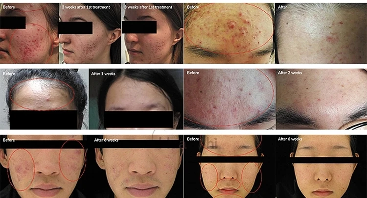 等离子喷射笔美容/纤维等离子笔美容美发设备