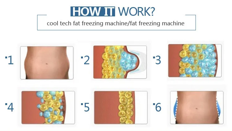 hot sale cryotherapy machine /cryo slimming machine /fat freezing machine slimming cryotherapy price
