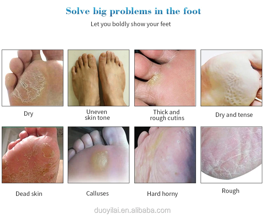 exfoliating dead skin on legs