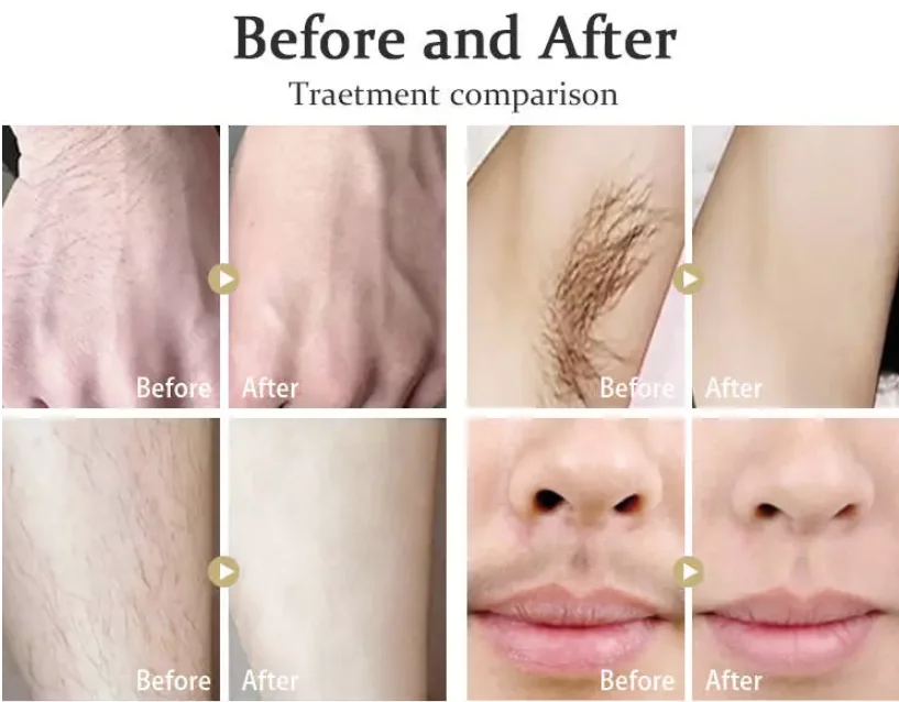 2020 Alma soprano ice laser hair removal machine laser 755 808 1064 triple wavelength diode laser hair removal machine