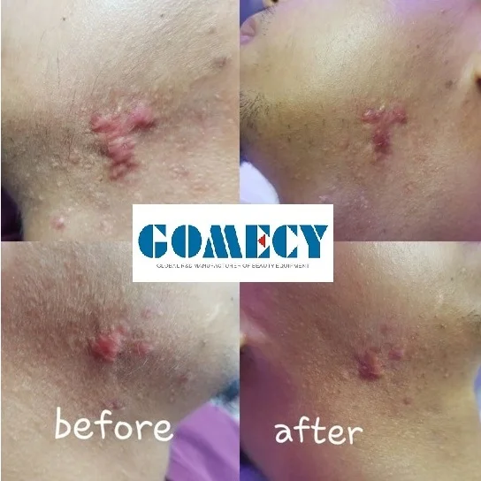 co2 hypertrophic scar remove.jpg