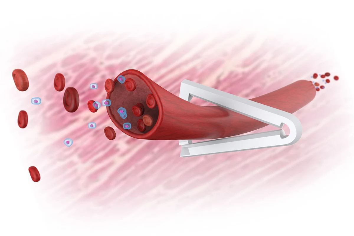 Disposable Medical Polymer Ligation Clips Buy Curved Open Surgery