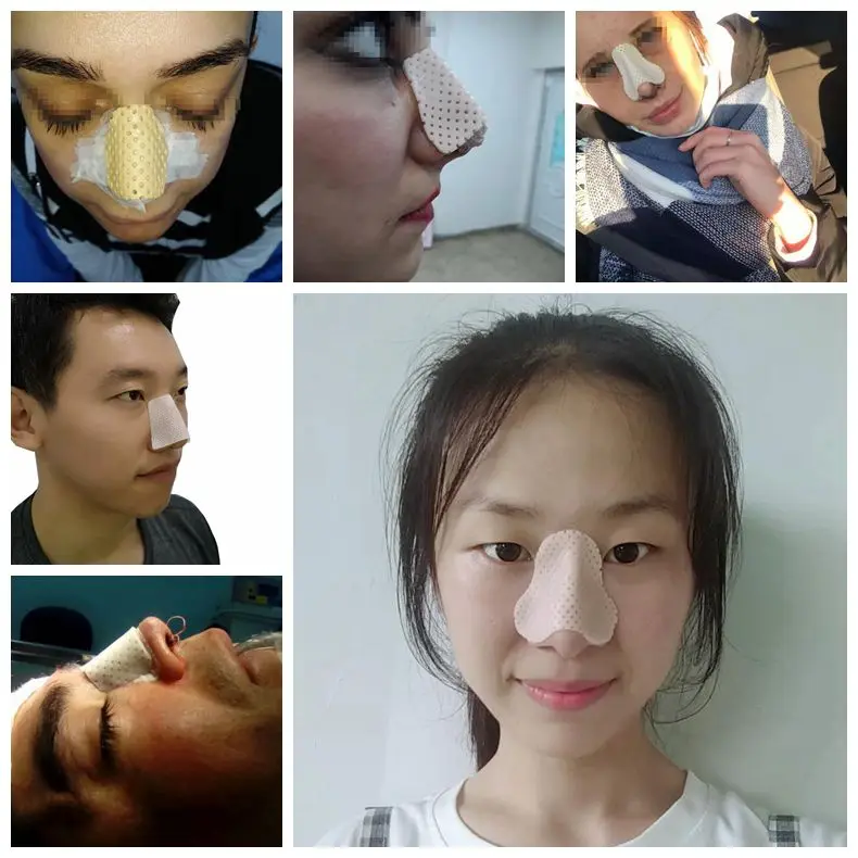 Nose Tip Rhinoplasty Splints After a Rhinoplasty Procedure ...