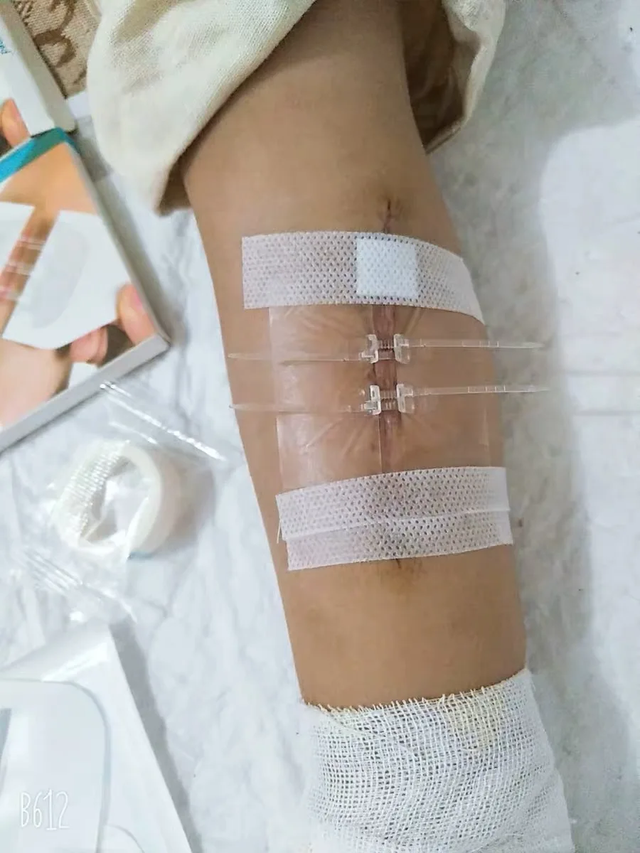 Zipstitch Zip Stitch First Aid Emergency Kit Wound Closure Device Steri