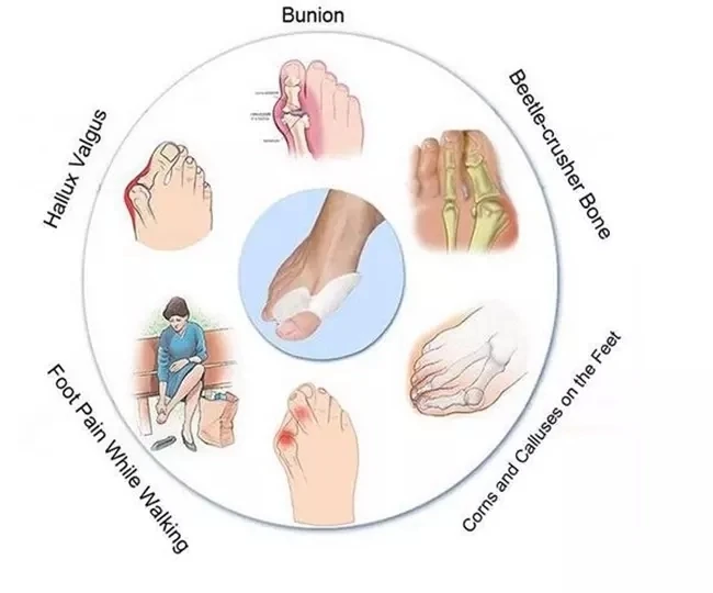 toe corrector (9).jpg