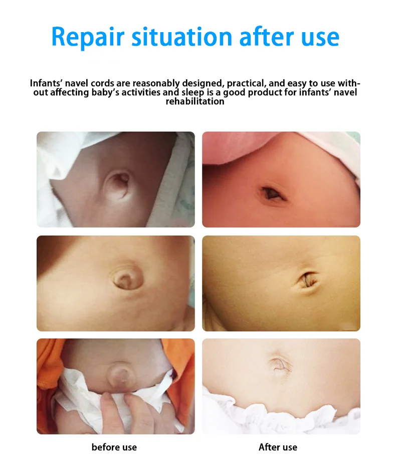 Children Medical Hernia With Umbilical Hernia Patch Bag To Restore Umbilical Baby Hernia Waist Bands Hospital Support Belt Buy Children Medical Hernia With Umbilical Hernia Patch Bag Restore Umbilical Baby Hernia Waist