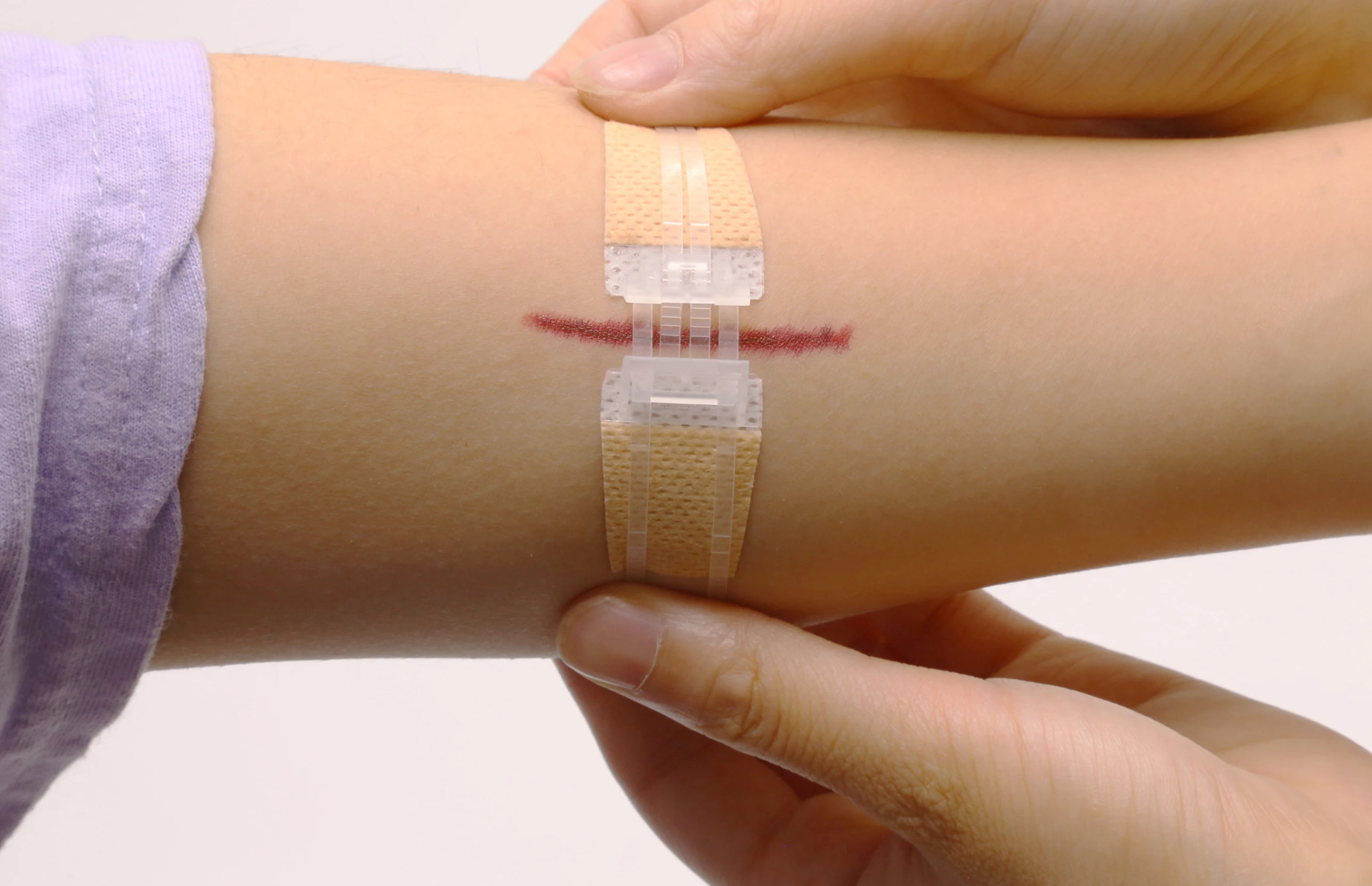 Zipstitch Zip Stitch First Aid Emergency Kit Wound Closure Device No Thread And Needle Stitches