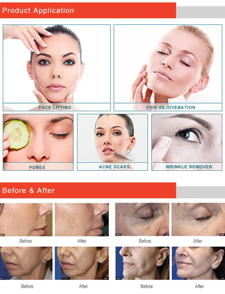 4 Cartridges secret microneedling rf 10/25/64 pins scar acne removal beauty machine