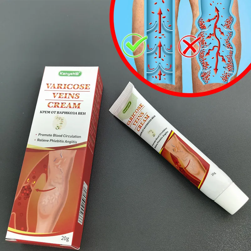 Kanyehb Varicose Veins Relief Cream Vasculitis Phlebitis Spider Pain
