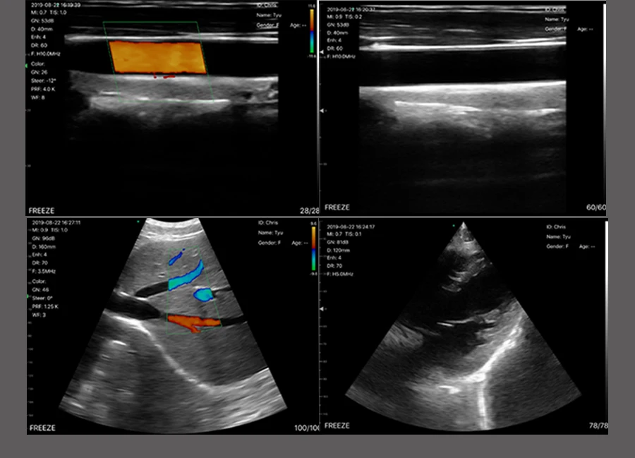 Sonostar Wireless 3 In 1 Pocket Ultrasound Cardiac Ultrasound Color Doppler Phased Array Probe