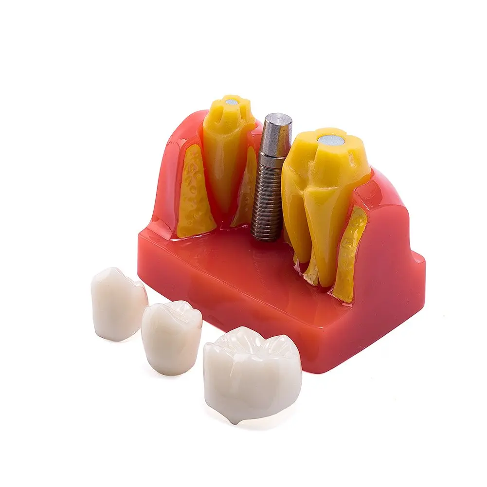 Dental 4 Times Implant Model Teeth Implant Analysis Crown Bridge ...