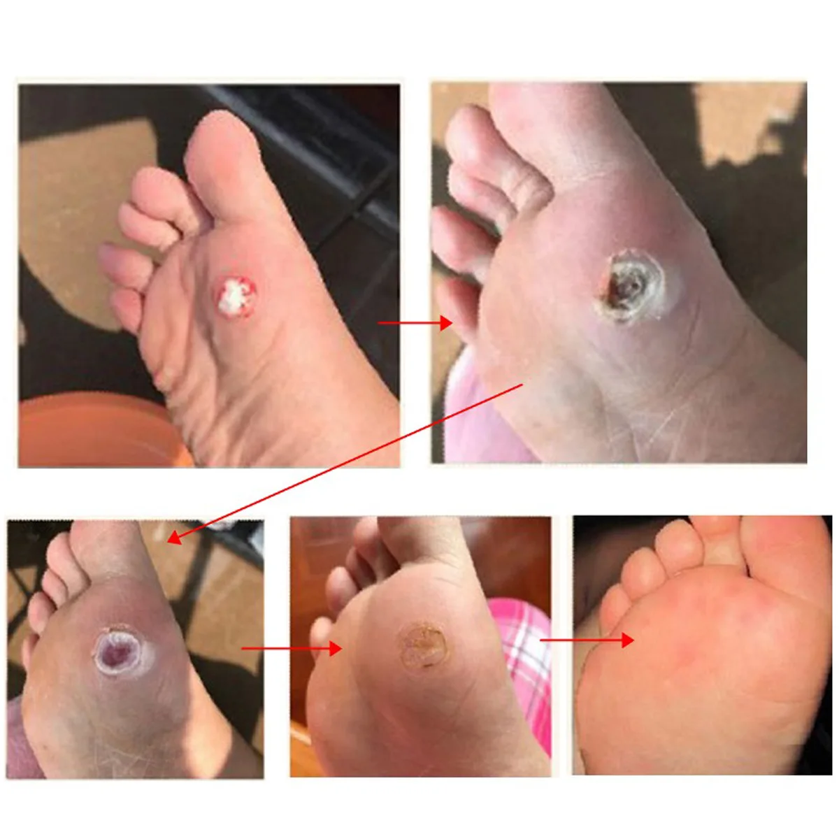 How to remove toe warts