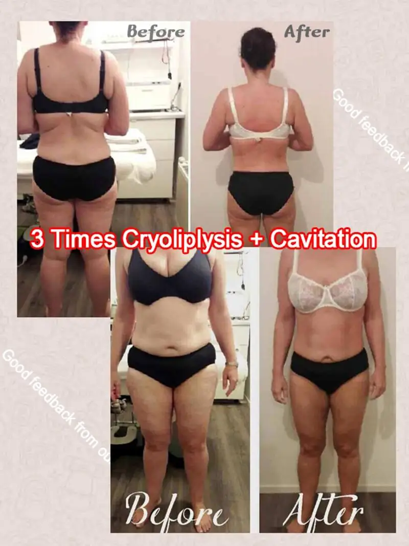 New cryolipolysis 360 degree cryo fat freezing machine portable cryolipolysis slimming machine with cavitation rf handles