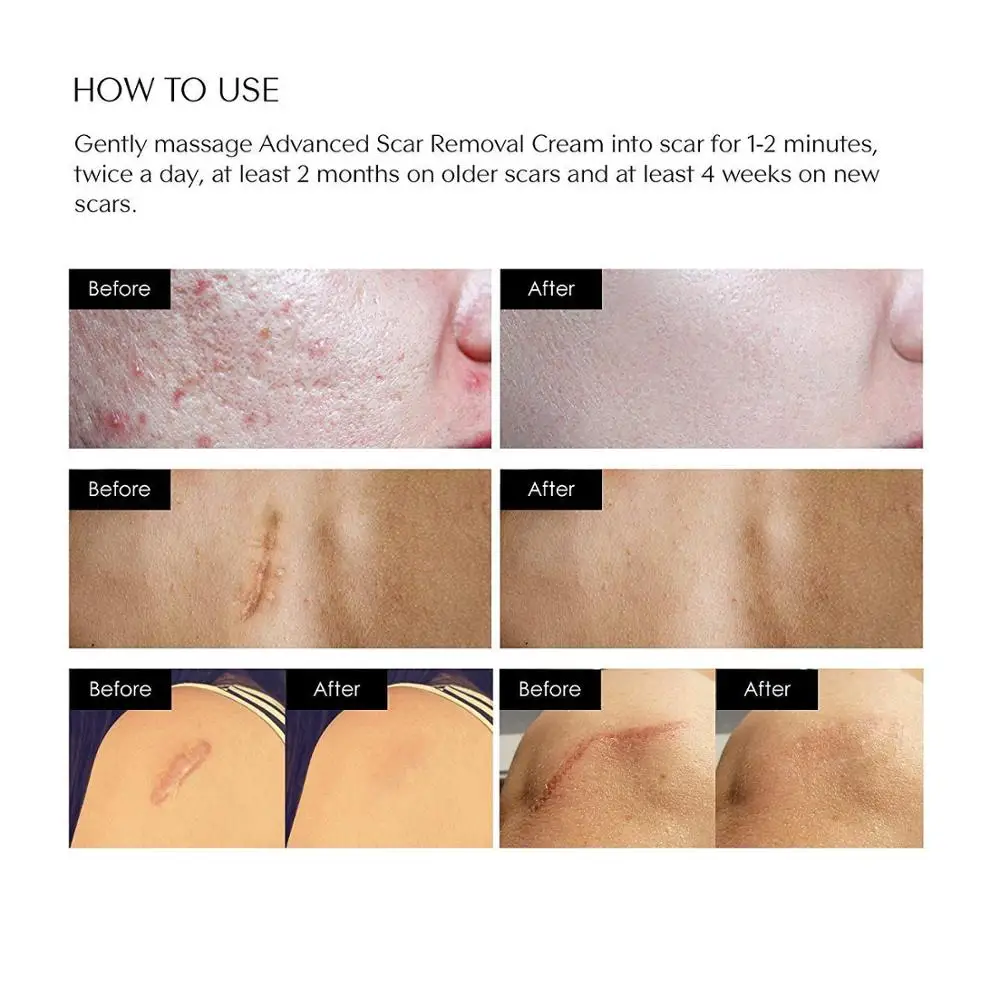 Wholesale Skin Scar Removal Cream For Pimple Acne Scar And Stretch