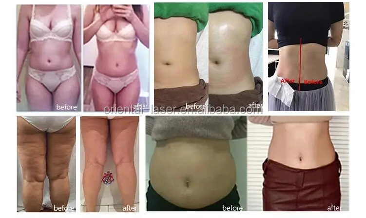  lipo 1060nm laser slimming machine reduce cellulite .jpg