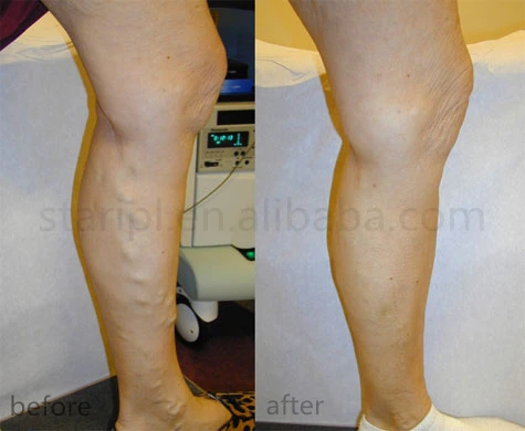 2023 Beijing Starlight 1470nm 980nm diode laser Endolifting Liposuction Laser Fat loss device