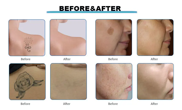 Picosecond-Laser Red Pico Laser