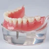 M6002 Dental Demonstration Model Lower Overdenture Inferior with 2 Implants+Red Gingvia+2 Implants