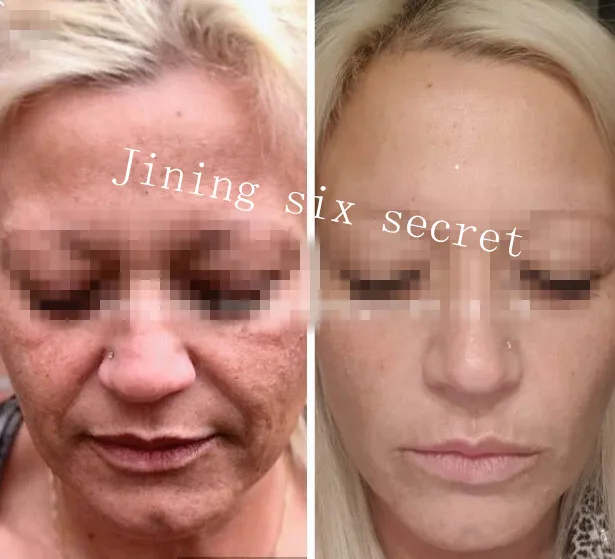 No Needle Air Pressure Injector Hyaluronic Acid Pen for Lips Filling.jpg