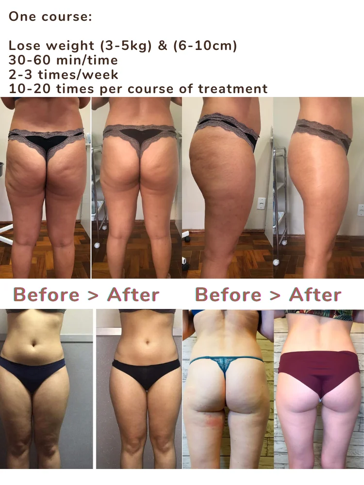 Liposuction machine surgery skin tightening machine body shaping