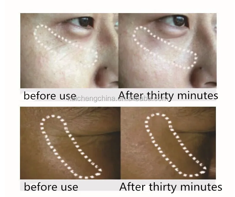 microneedle eye patch